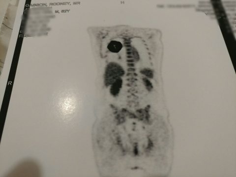 PET scan showing Rod's tumor in his chest.